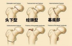 股骨头坏死的保守治疗！中成药可行吗？