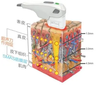 什么是Antisonic 超声刀?