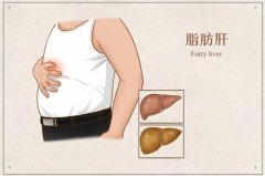 首舒养生小百科 ｜ 脂肪肝